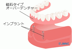 インプラントオーバーデンチャー