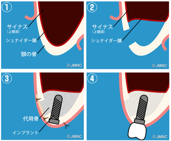 サイナスリスト