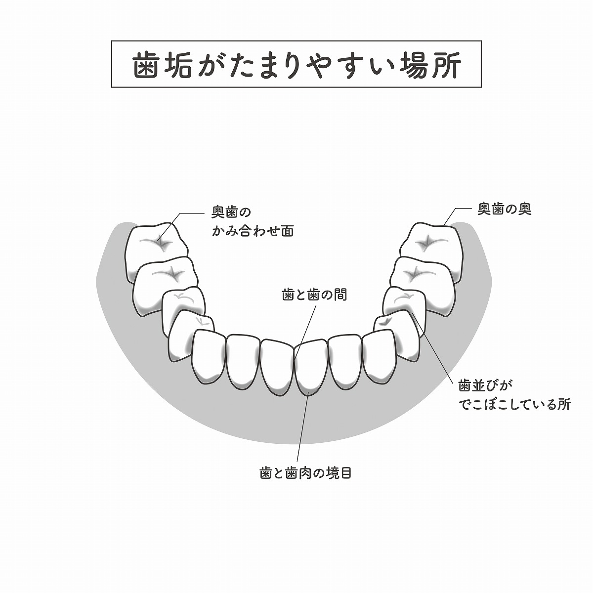 むし歯になりやすい箇所