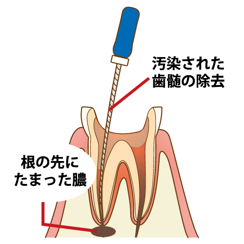 根管内の清掃