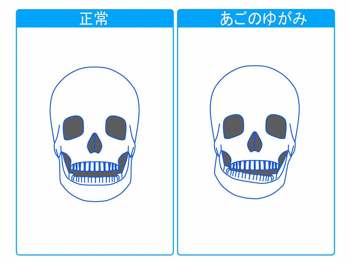 顎関節症