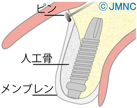 GBR法(骨再生誘導法)