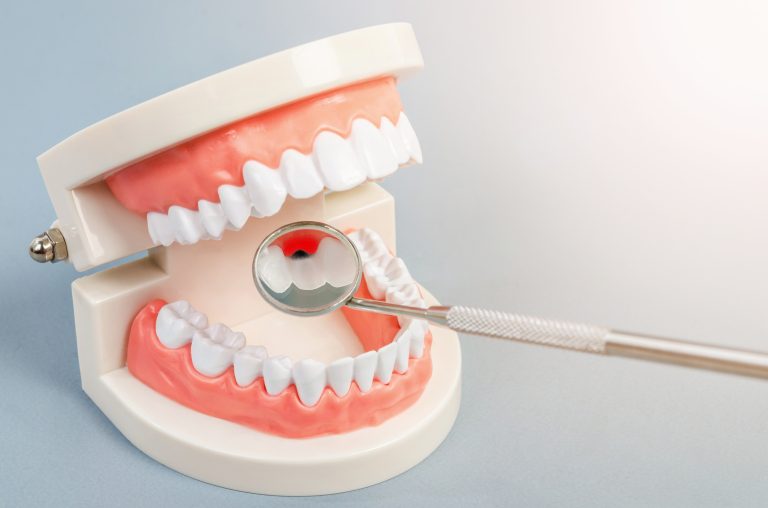 虫歯、歯周病やお口の中の組織のチェック