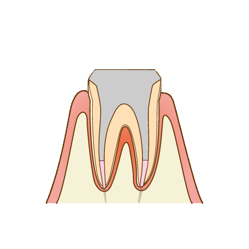 充填剤を充填